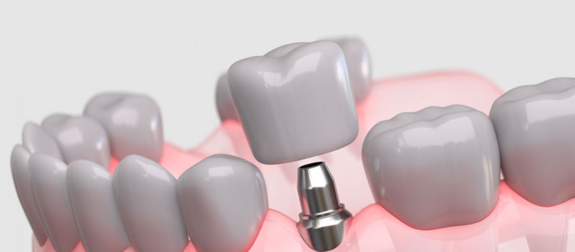 Highly detailed 3D illustration showing a dental implant in place within the jawbone and gum tissue.