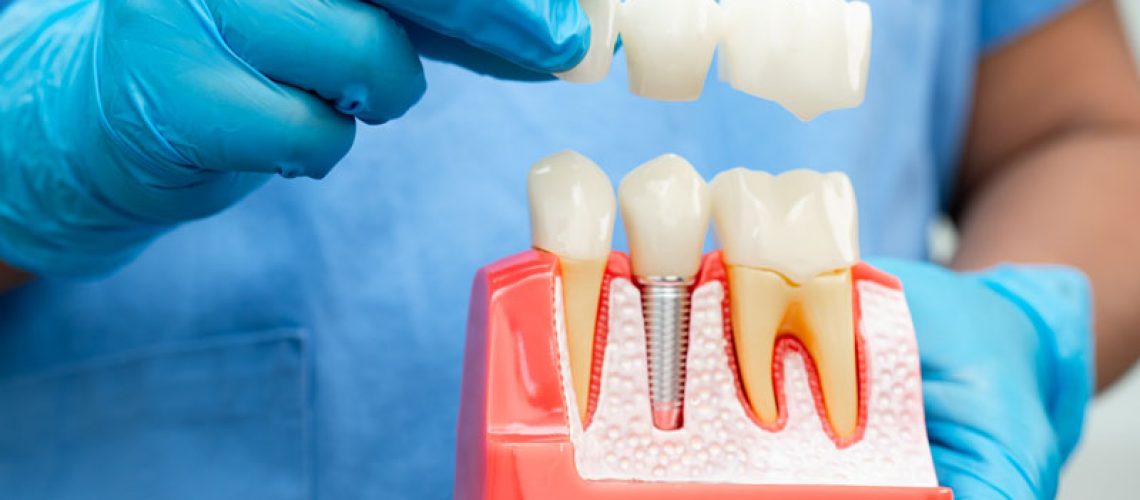 A dental professional wearing blue gloves holds a model showing a dental implant in the jawbone, demonstrating how a bridge fits over the implant and natural teeth.