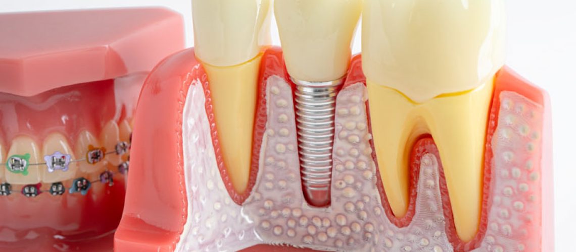Dental implant, artificial tooth roots into jaw, root canal of dental treatment, gum disease, teeth model for dentist studying about dentistry.