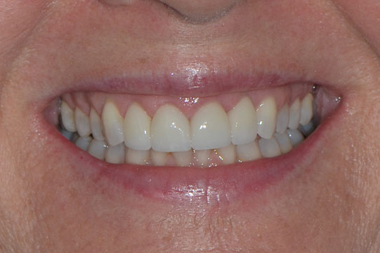 Close-up of a patient’s smile after receiving dental veneers, showing aligned, white, and symmetrical teeth