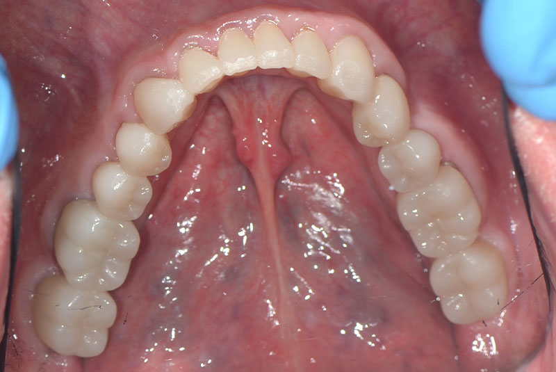 after dental treatment