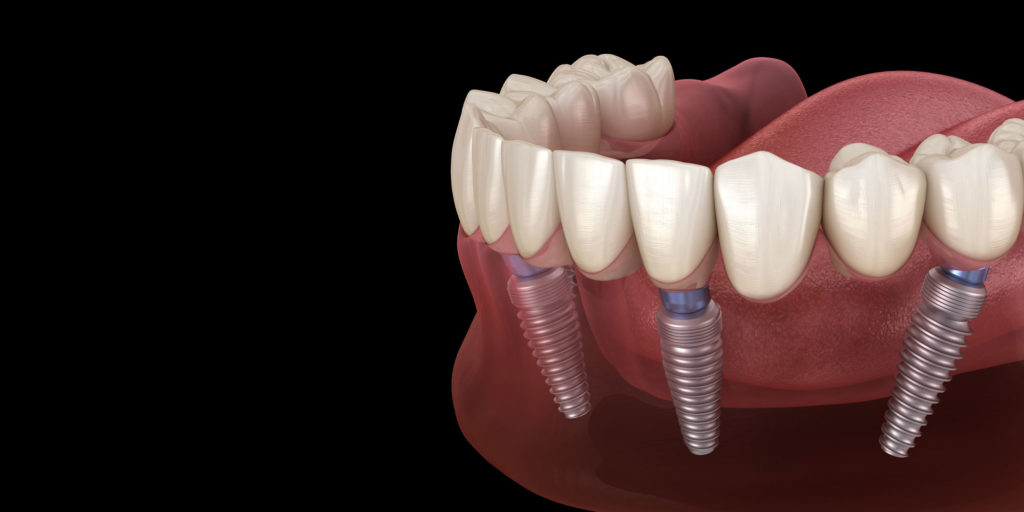 3D model of All-on-4 dental implants supporting a full arch of lower teeth