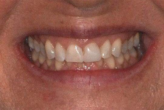 Close-up of a patient’s smile before getting dental veneers, showing natural teeth alignment and discoloration