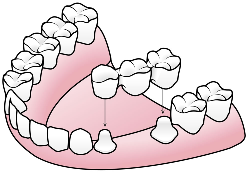 Illustration showing how a dental bridge replaces missing teeth using adjacent crowned teeth for support
