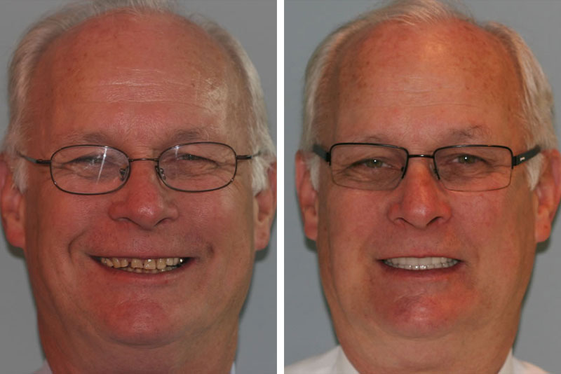 dental crowns before and after