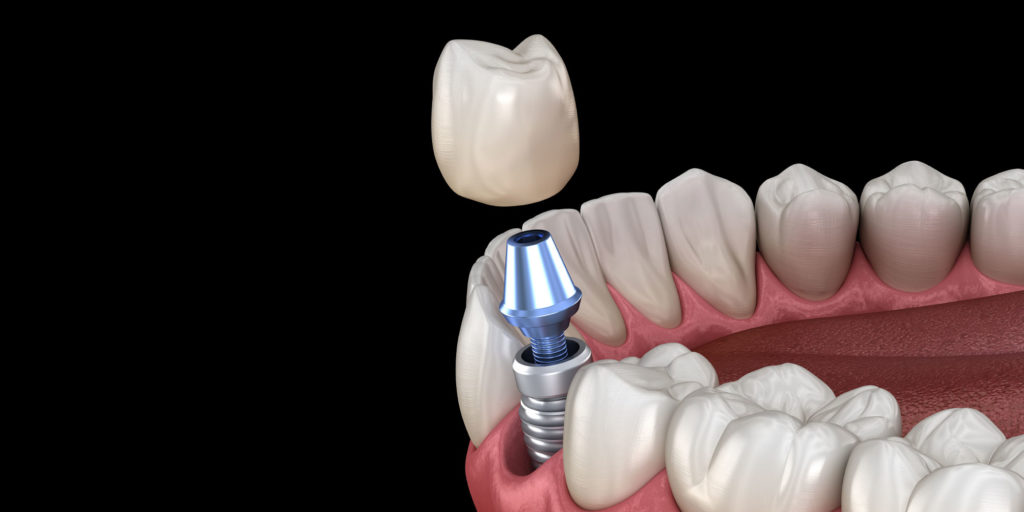 3D illustration of a single dental implant showing titanium post, abutment, and crown for tooth replacement