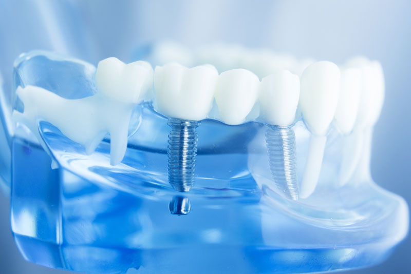 dental implants model