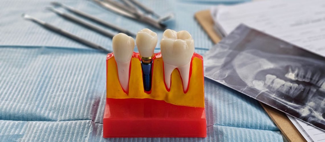 Dental implant, artificial tooth roots into jaw, root canal of dental treatment, gum disease, teeth model for dentist