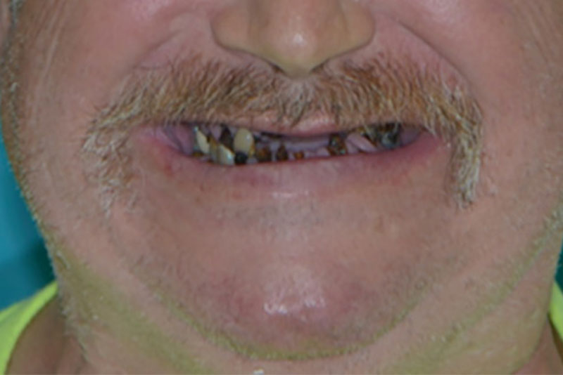 dentures case1 before