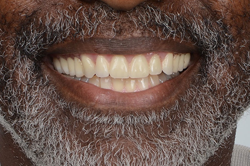 dentures case2 after