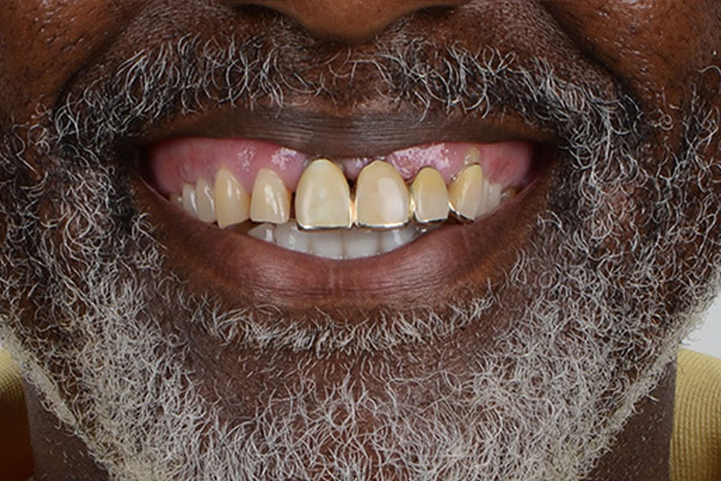 dentures case2 before