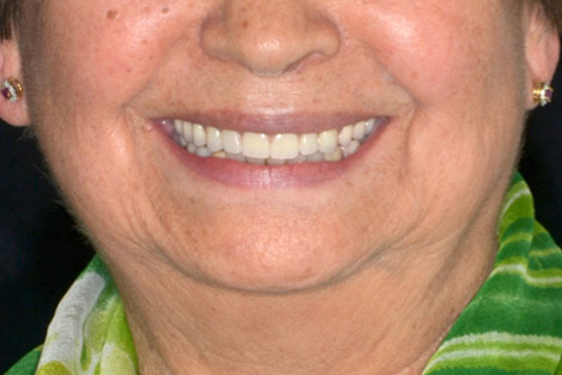 dentures case3 after