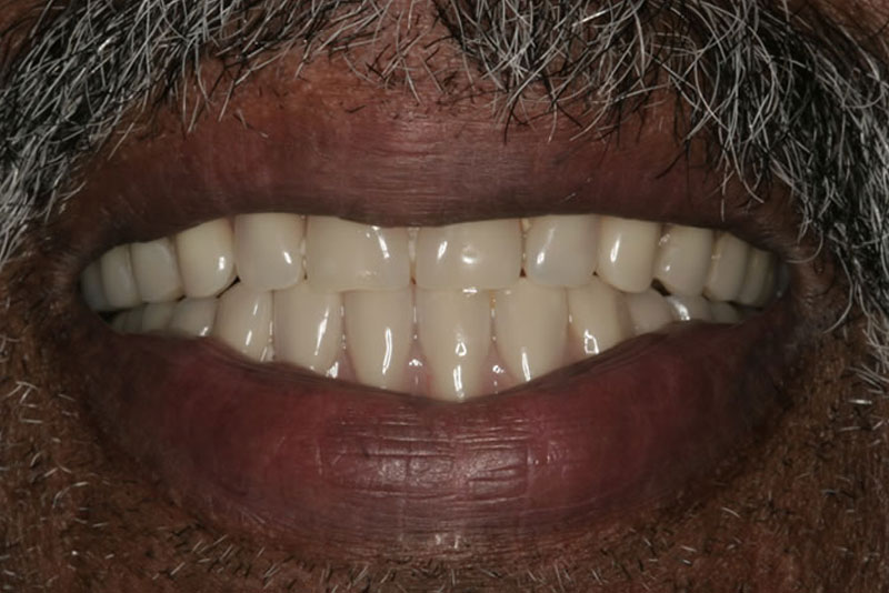 dentures case4 after