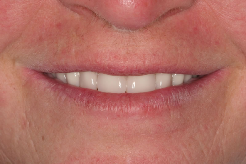 dentures case5 after