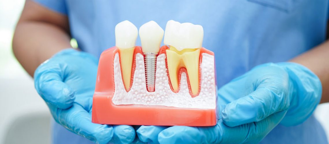Doctor hold dental implant, artificial tooth roots into jaw, root canal of dental treatment, gum disease, teeth model for dentist studying about dentistry
