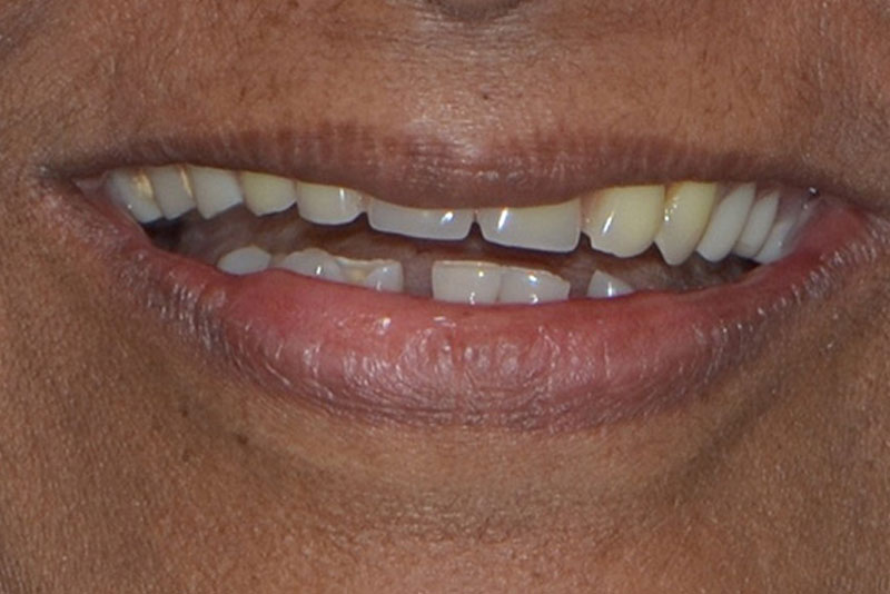 full mouth reconstruction case 4 before