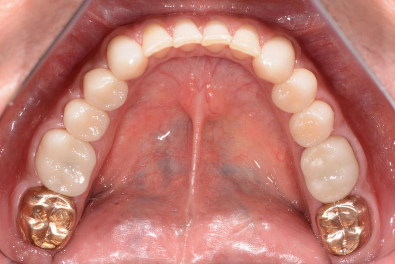 full mouth rehabilitation case1 after