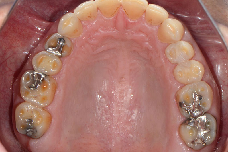 full mouth rehabilitation case2 before