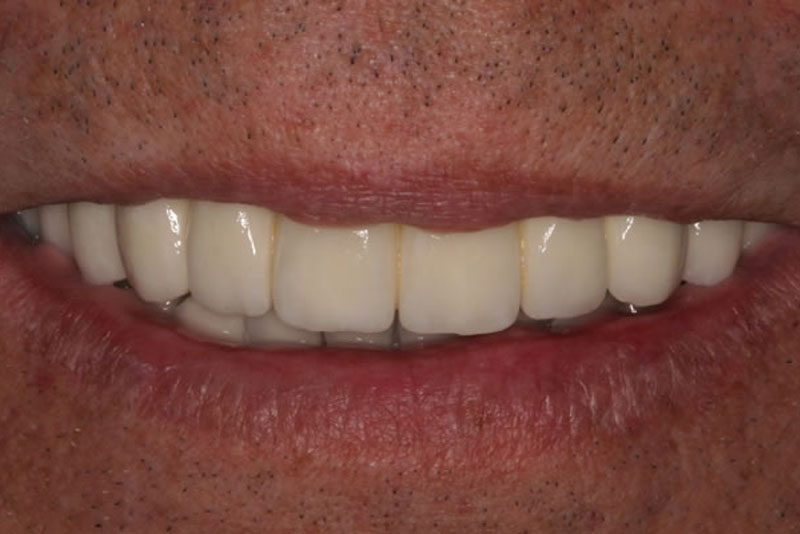 full arch case1 after