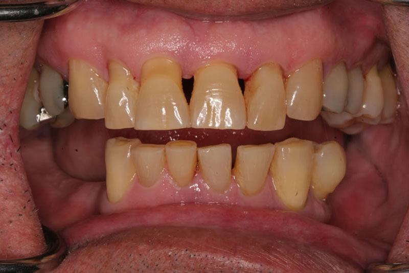 full arch case2 before