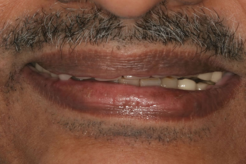 implant bridge case1 before