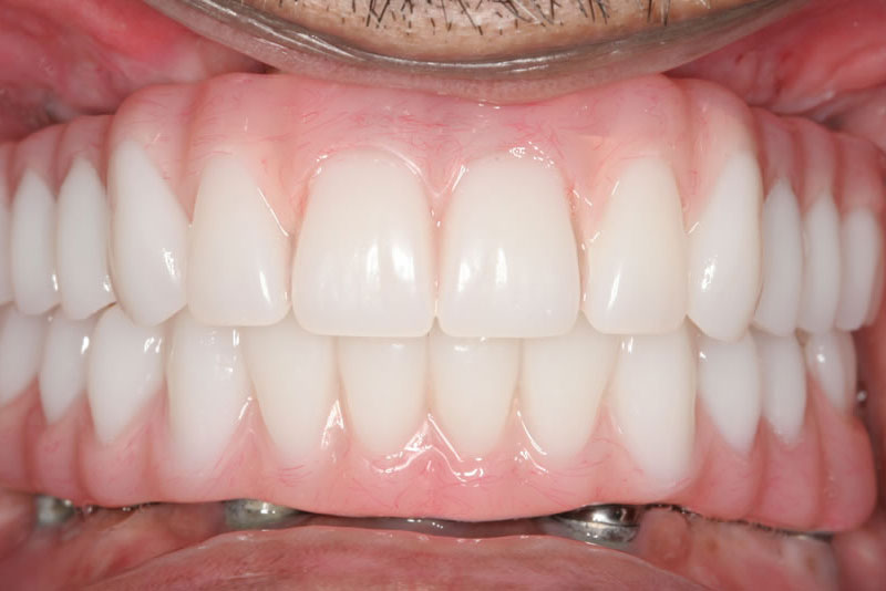 implant bridge case2 after