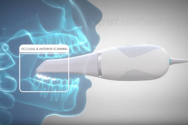 intraoral camera graphic