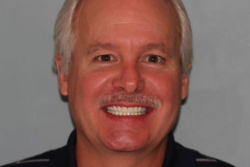 multiple crowns case1 after