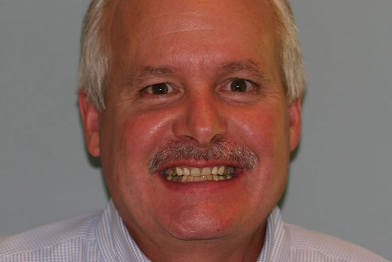 multiple crowns case1 before