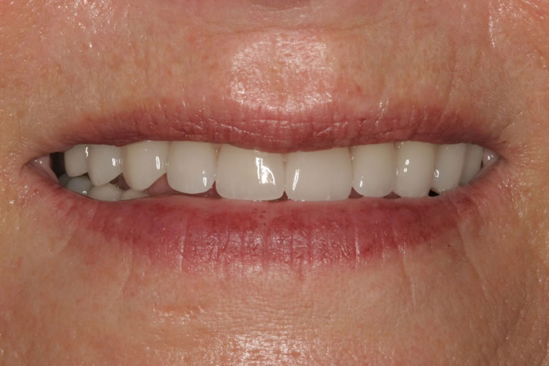 multiple crowns case4 after