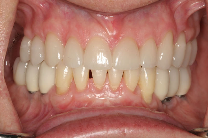 multiple crowns case5 after