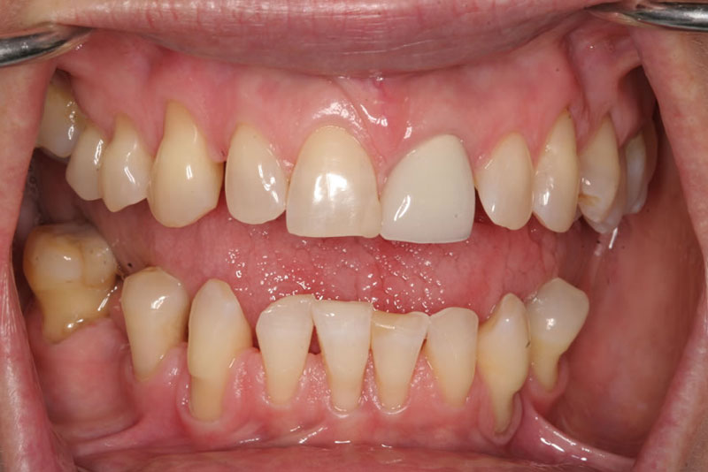 multiple crowns case5 before