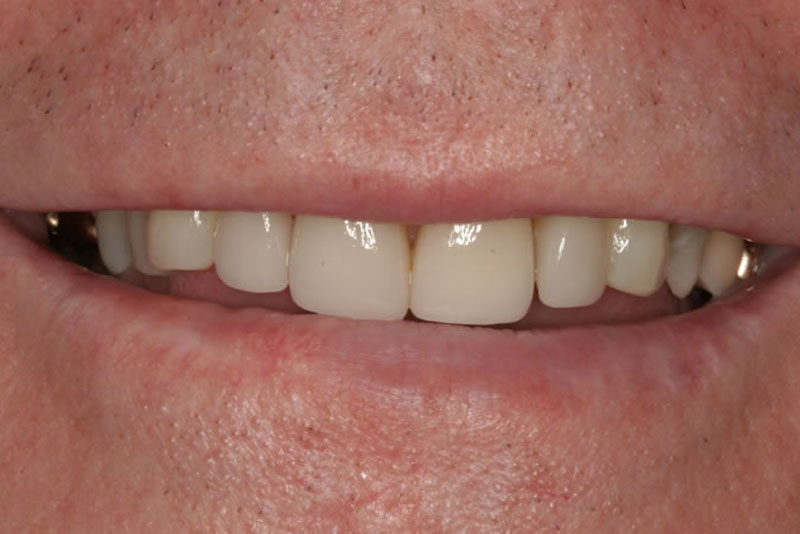 multiple crowns case7 after