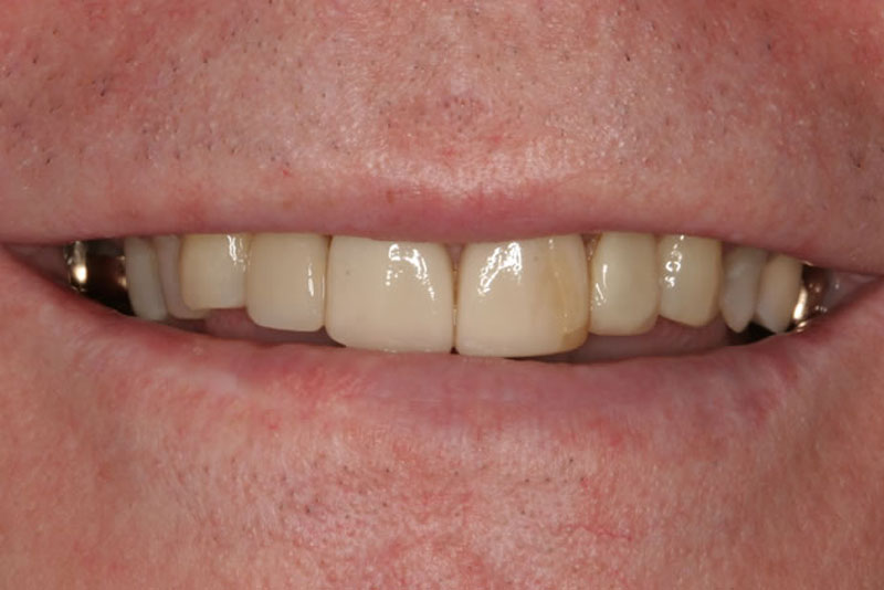 multiple crowns case7 before