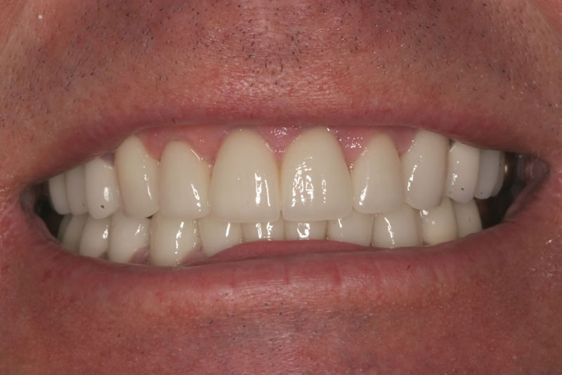 orthocrown case1 after