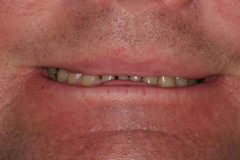 orthocrown case1 before