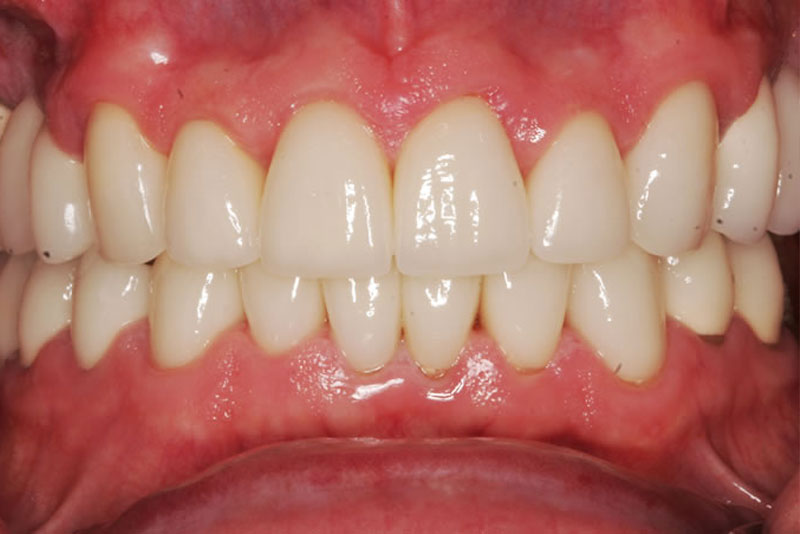 orthocrown case2 after