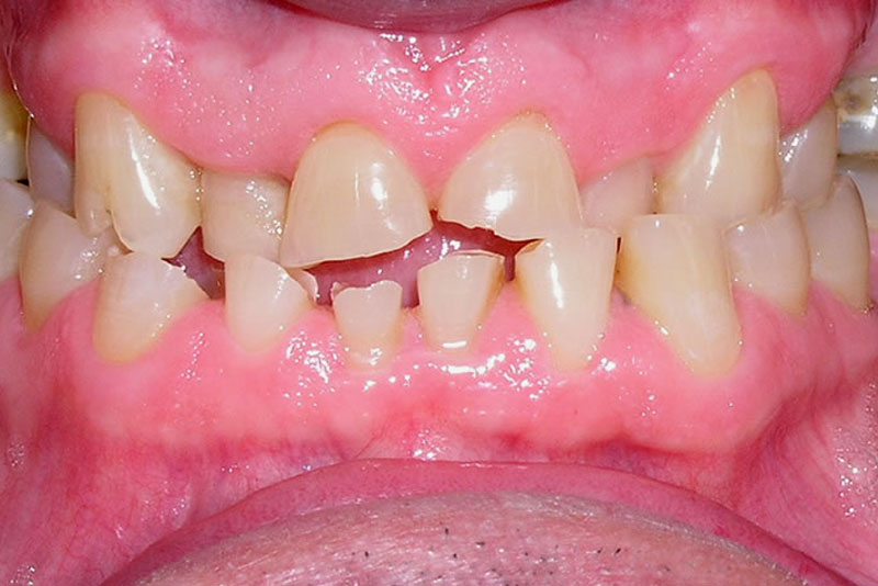 orthocrown case2 before