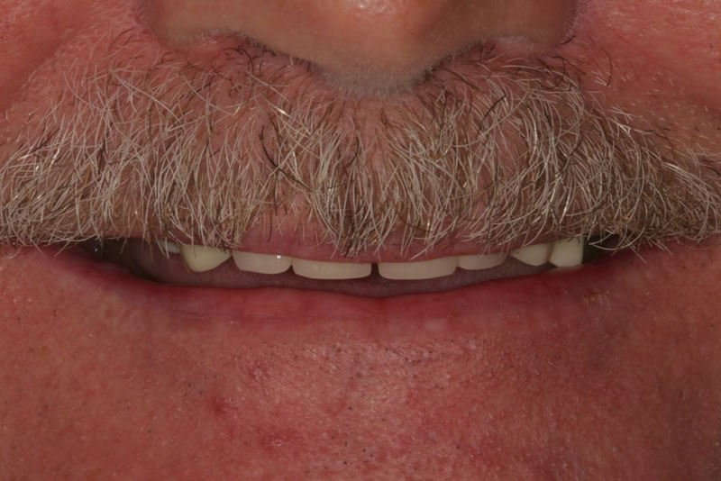 permanent dental bridge case1 before