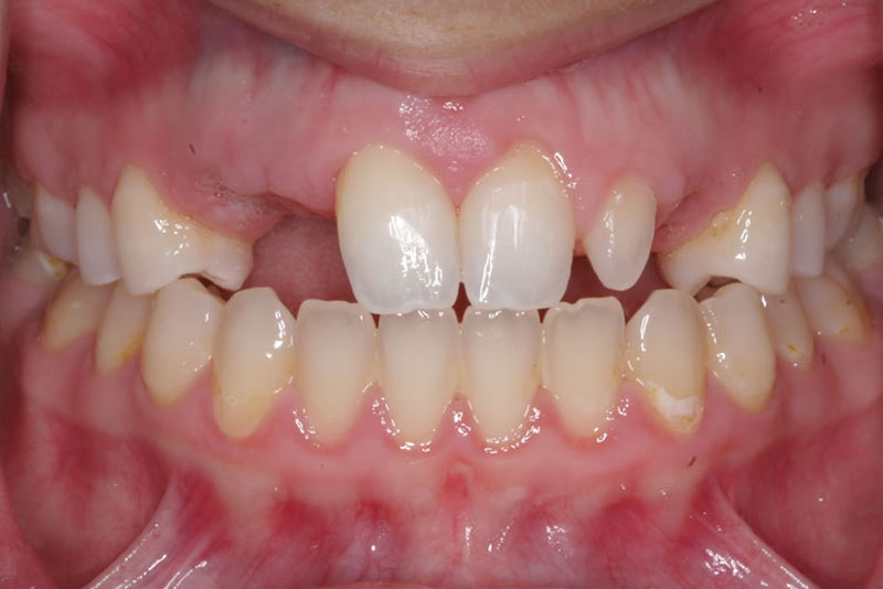 reconstructive dentistry case2 before