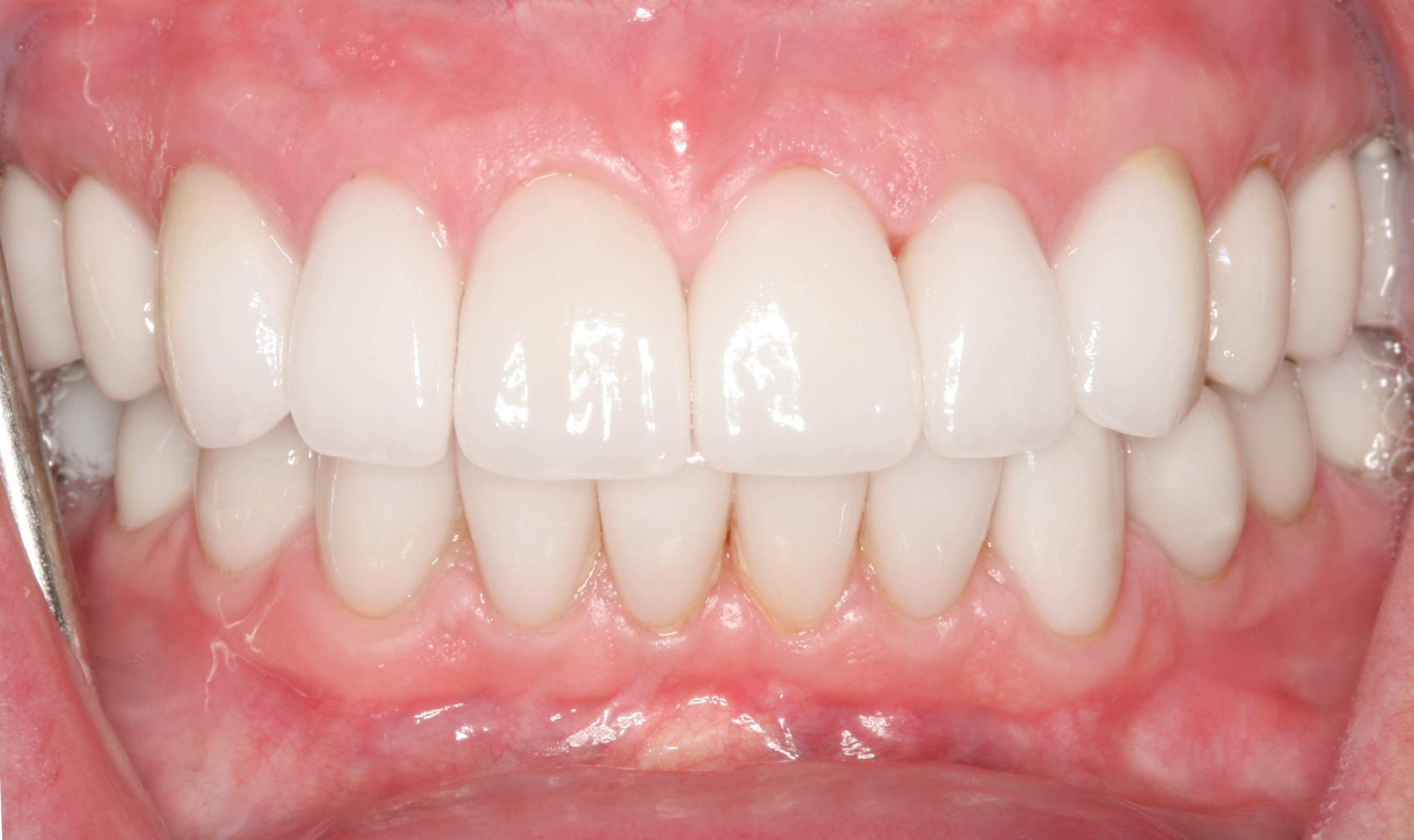 Close-up of full upper and lower teeth after cosmetic dental treatment with veneers or crowns