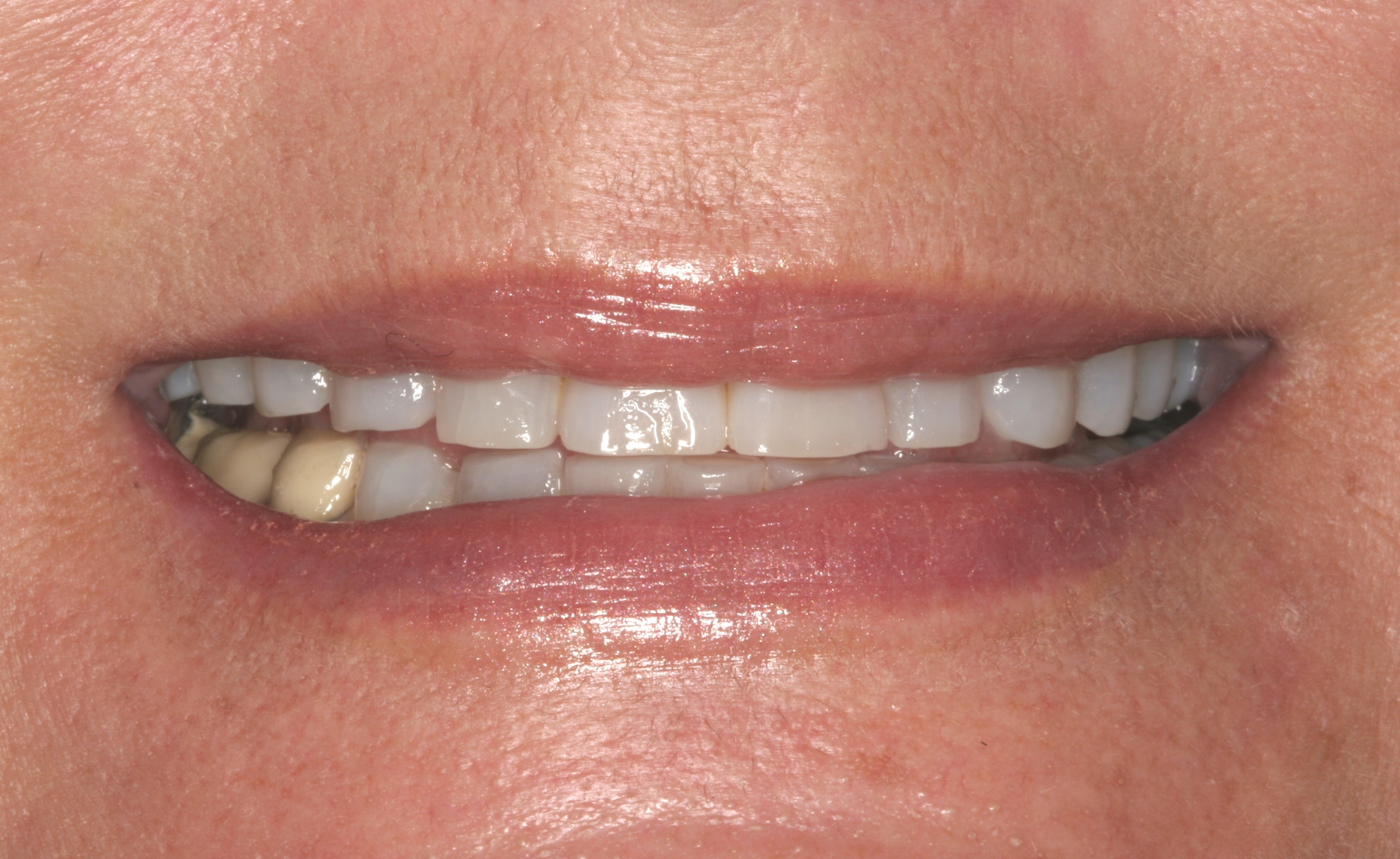 Close-up of a patient’s smile showing visible dental crown and tooth alignment before cosmetic treatment
