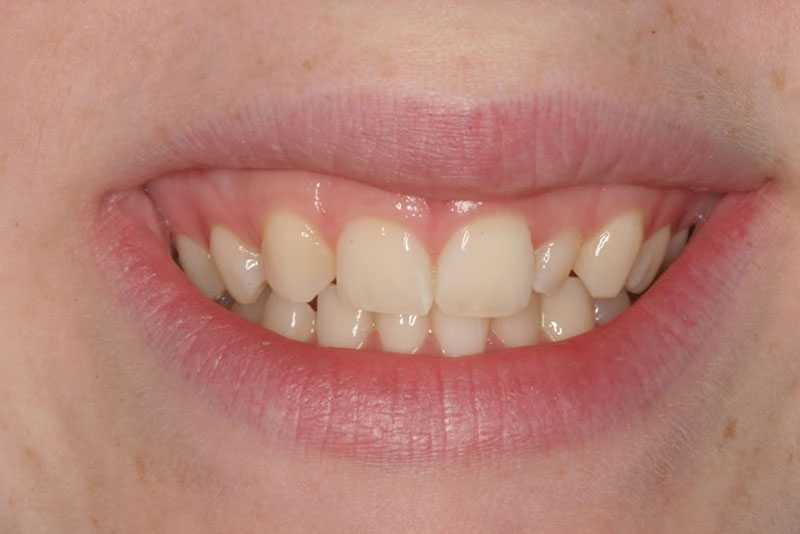 smile makeover case 4 before