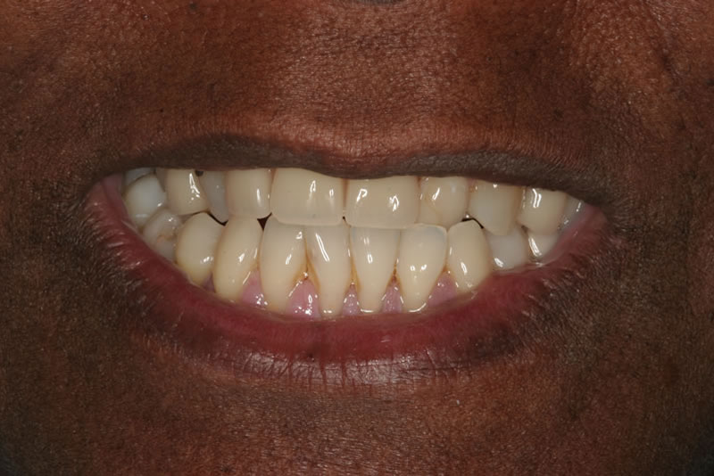 smile makeover case1 after