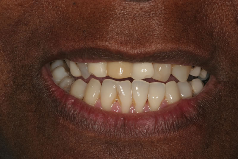 smile makeover case1 before