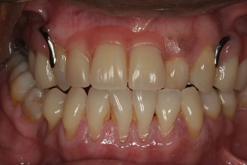 smile makeover case2 after