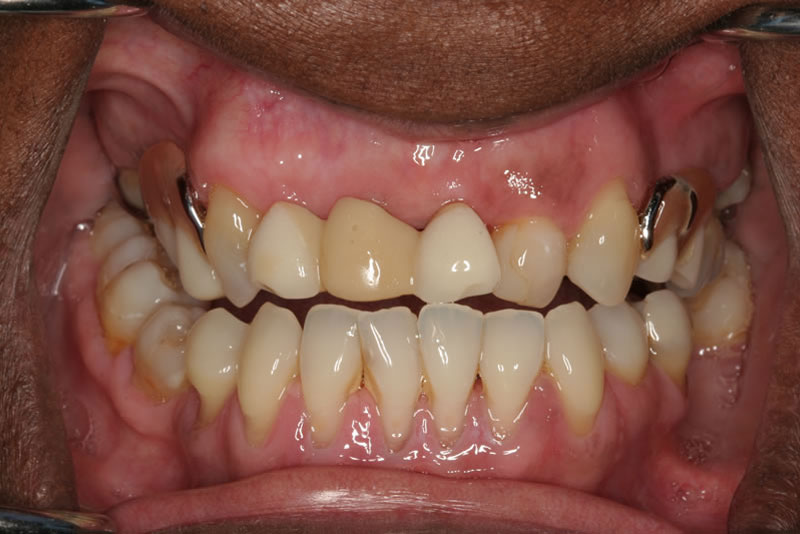 Close-up of upper and lower teeth showing severe discoloration, tooth damage, and dental crowns before smile makeover