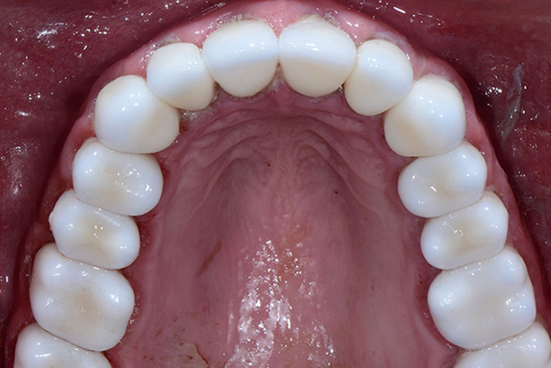 smile makeover case3 after