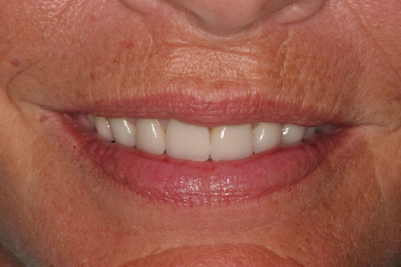 veneers case1 after