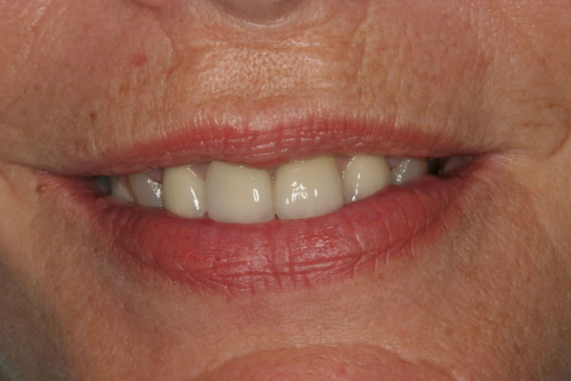 veneers case1 before